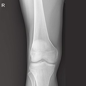 Browiner MobileApex Series Redefining Intelligent Radiography