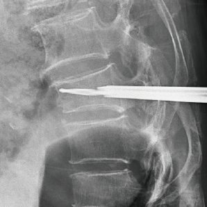 Browiner CompaX 500 Series Surgical C-arm System With FPD