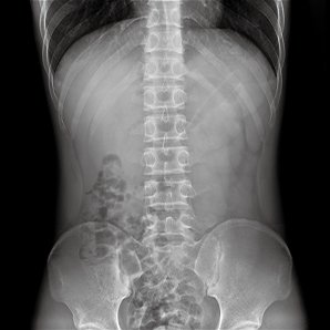 Browiner MobileCooper Series Economical and High-performance Mobile X-ray System
