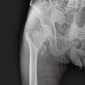 Browiner MobileCooper Series Economical and High-performance Mobile X-ray System