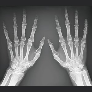 Browiner Portable X-ray System