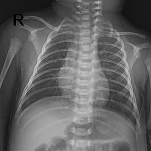 Browiner Beatle-06P(Neo DR) Pediatric X-ray imaging system