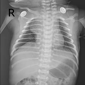 Browiner Beatle-06P(Neo DR) Pediatric X-ray imaging system