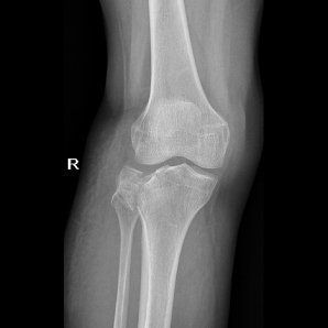 Browiner Beatle-01P Handheld Portable Digital X-Ray System