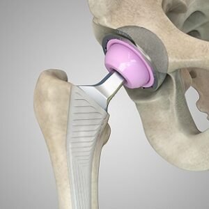 Become Mindray Orthopaedic Supplies and Products Distributor
