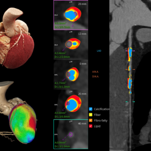 United Imaging uCT Cardiovascular Combined Analysis