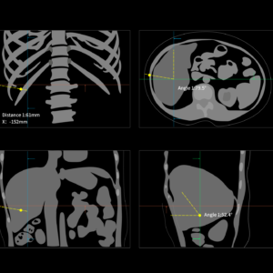 United Imaging uCT Guided Intervention