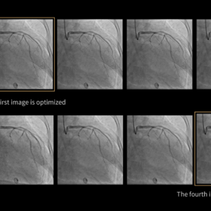 United Imaging uAngio Aviva