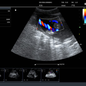 Yonker New Yonker Cheap Portable Color Doppler Ultrasound Machine PU-L151A